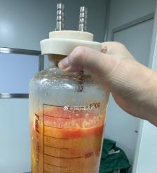 邵阳水动力吸脂手术要做多久？